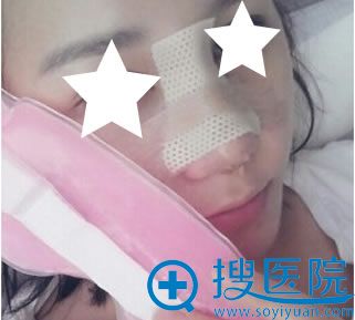 韩国隆鼻修复术后第三天照片 韩国隆鼻修复术后第三天照片