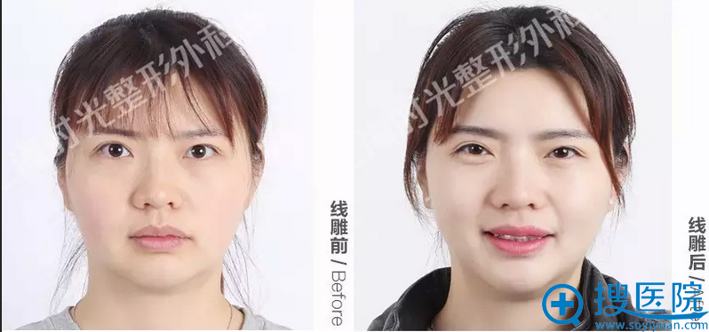 宝妈Anne线雕一个月正面对比照 宝妈Anne线雕一个月正面对比照