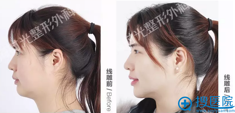 宝妈Anne线雕一个月侧面对比照 宝妈Anne线雕一个月侧面对比照
