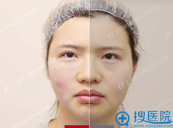宝妈Anne半脸对比照 宝妈Anne半脸对比照