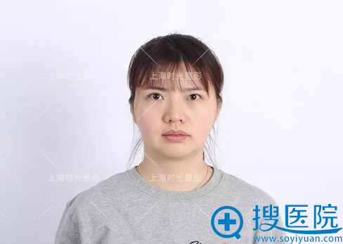 上海时光整形面部线雕提升真人案例 宝妈变身小仙女