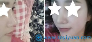 隆鼻修复后第20天照片 隆鼻修复后第20天照片