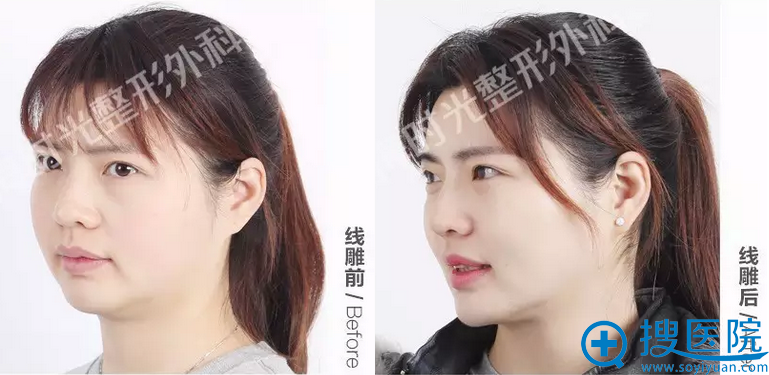 宝妈Anne线雕一个月45°角对比照 宝妈Anne线雕一个月45°角对比照