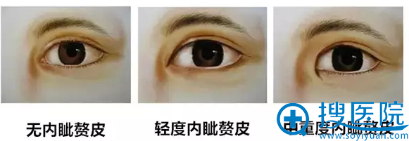 20-28岁年轻女性眼部出现的问题 20-28岁年轻女性眼部出现的问题