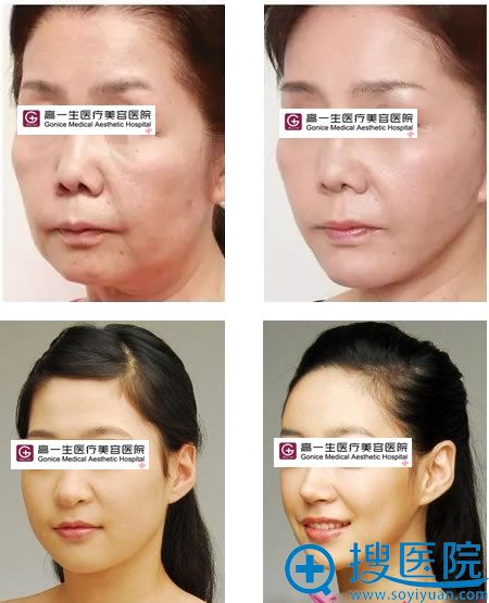 西安高一生面部线雕案例效果图 西安高一生面部线雕案例效果图
