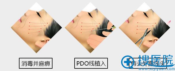 西安高一生面部线雕手术过程 西安高一生面部线雕手术过程
