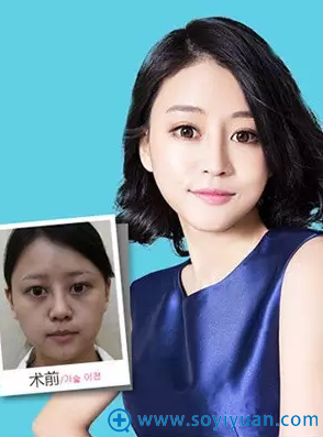武汉美立方半纹眉真人案例 武汉美立方半纹眉真人案例