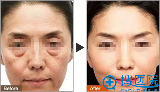 苏州美贝尔整形医院童艳梅教授除皱案例 苏州美贝尔整形医院童艳梅教授除皱案例