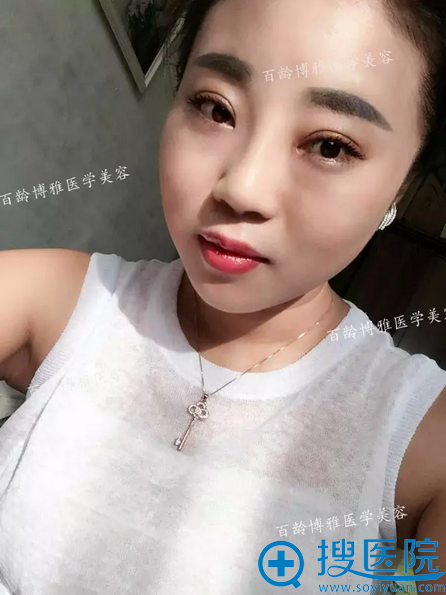 ˫��Ƥ���������ܣ�14�죩�ָ�ͼ