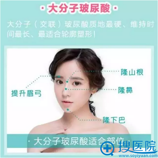 大分子玻尿酸的效果 大分子玻尿酸的效果