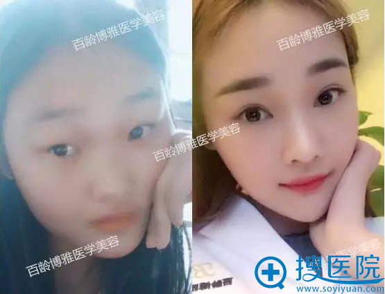 <!--<i data=20240710 data-id=12473></i>-->博雅双眼皮+隆鼻案例 <!--<i data=20240710 data-id=12473></i>-->博雅双眼皮+隆鼻案例