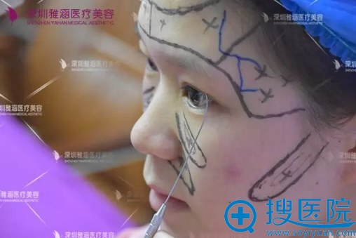 【案例】刚在深圳雅涵医疗整形找高山隆鼻子3个月 看效果怎么样