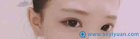 上海伊莱美埋线双眼皮十天恢复图 上海伊莱美埋线双眼皮十天恢复图