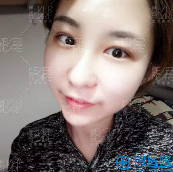 术后14天,大家都说我现在气质都不一样了 术后14天,大家都说我现在气质都不一样了