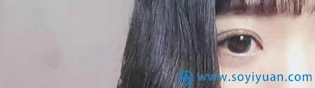 上海伊莱美埋线双眼皮二十天照片 上海伊莱美埋线双眼皮二十天照片
