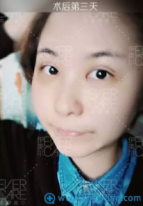 5S重睑术第3天的样子 5S重睑术第3天的样子