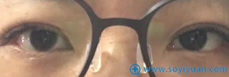 在上海伊莱美做完埋线双眼皮的照片 在上海伊莱美做完埋线双眼皮的照片