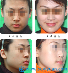 <!--<i data=20240710 data-id=11797></i>-->美容整形医院瘦脸术案例 <!--<i data=20240710 data-id=11797></i>-->美容整形医院瘦脸术案例
