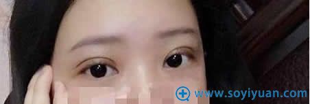 上海伊莱美做埋线双眼皮术后5天照片 上海伊莱美做埋线双眼皮术后5天照片