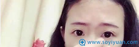 在上海伊莱美做埋线双眼皮前照片 在上海伊莱美做埋线双眼皮前照片