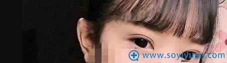 上海伊莱美做双眼皮术后15天照片 上海伊莱美做双眼皮术后15天照片