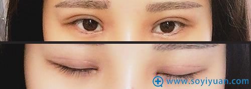 在重庆时光做双眼皮修复术第十五天 在重庆时光做双眼皮修复术第十五天