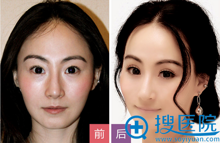 <!--<i data=20240710 data-id=12520></i>-->整形医院双眼皮案例 <!--<i data=20240710 data-id=12520></i>-->整形医院双眼皮案例