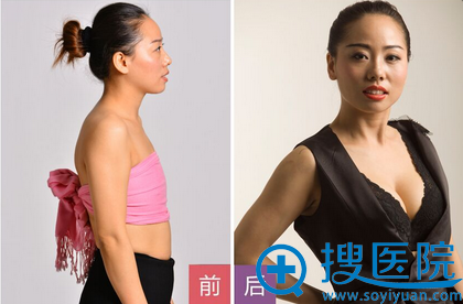 <!--<i data=20240710 data-id=12520></i>-->整形医院丰胸整形案例 <!--<i data=20240710 data-id=12520></i>-->整形医院丰胸整形案例