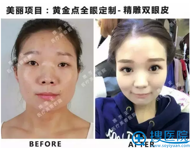 全切双眼皮术前术后对比照 全切双眼皮术前术后对比照