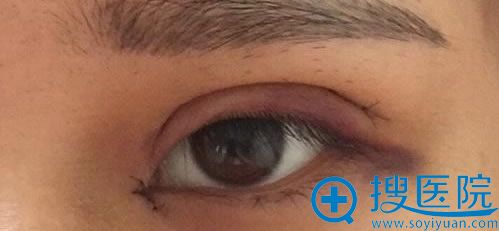 在重庆时光做双眼皮修复术第六天 在重庆时光做双眼皮修复术第六天