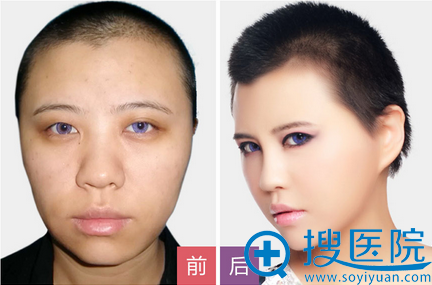 <!--<i data=20240710 data-id=12520></i>-->整形医院鼻部整形案例 <!--<i data=20240710 data-id=12520></i>-->整形医院鼻部整形案例