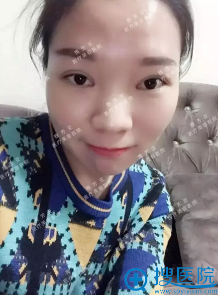 双眼皮6天恢复效果 双眼皮6天恢复效果