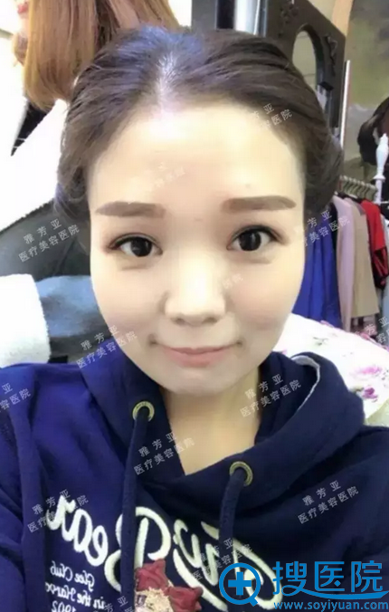 全切双眼皮15天后的样子 超自然 全切双眼皮15天后的样子 超自然