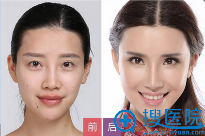<!--<i data=20240710 data-id=12520></i>-->整形医院双眼皮+面部微雕案例 <!--<i data=20240710 data-id=12520></i>-->整形医院双眼皮+面部微雕案例