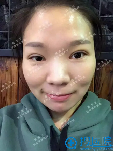 全切双眼皮术后4天恢复图 全切双眼皮术后4天恢复图