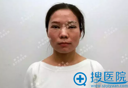 全切双眼皮术后即刻效果 全切双眼皮术后即刻效果