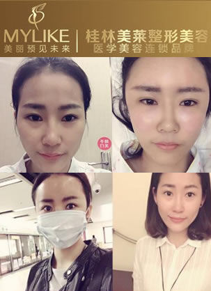 分享我在桂林美莱整形找曹继武做自体脂肪填充后十天图