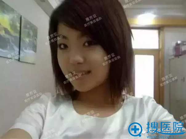 分享我在石家庄雅芳亚做假体隆鼻+双眼皮的真实经历 7天恢复图