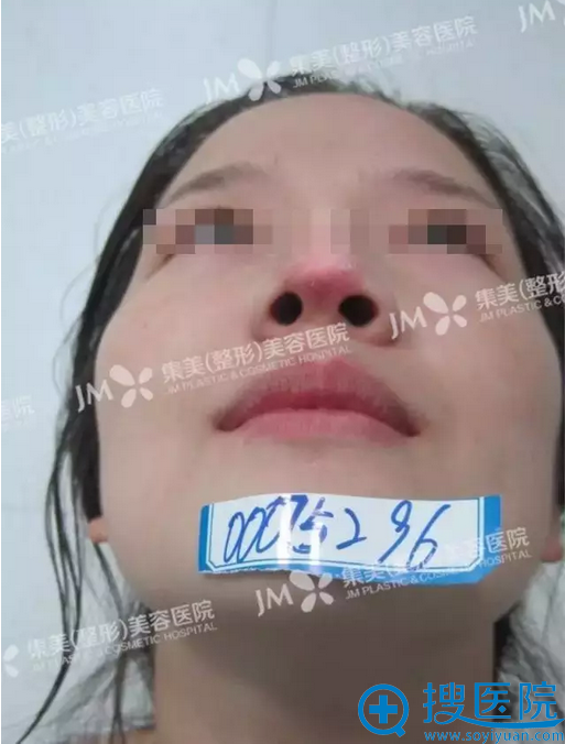 【经历】分享刚在郑州集美整形医院做隆鼻修复妹子的恢复过程图