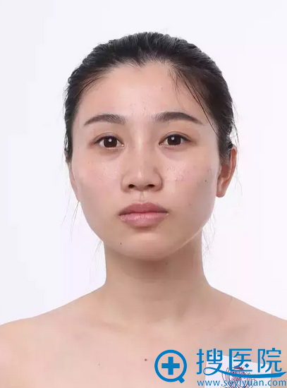 【真实经历】去上海伊莱美整形医院找李湘原做下颌角手术两个月