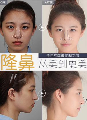 北京玉之光唐振利做的鼻子好么?鼻尖下垂整形真实案例图片