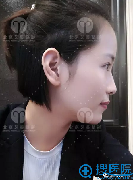 手术一个月后生活照 手术一个月后生活照