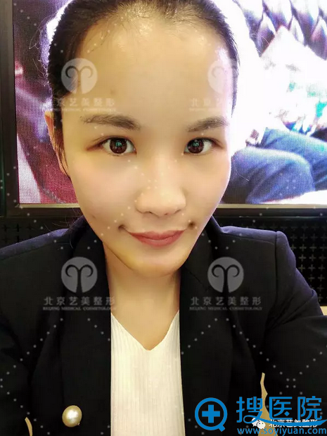 术后第三天照片,还是有些肿 术后第三天照片,还是有些肿
