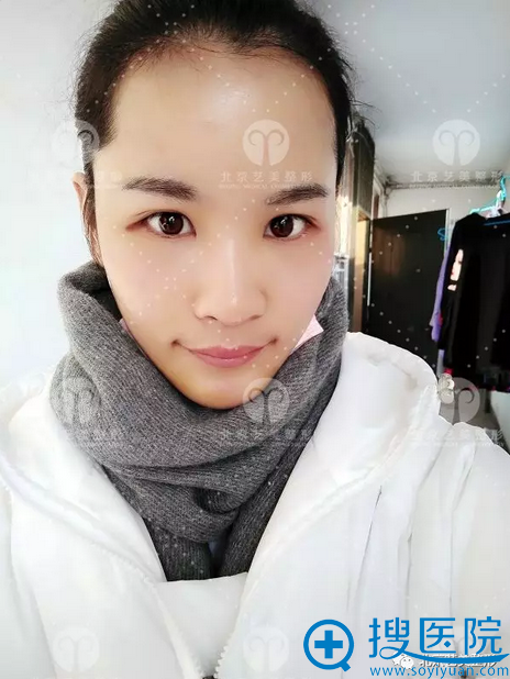 术后第七天,皮肤好好啊 术后第七天,皮肤好好啊