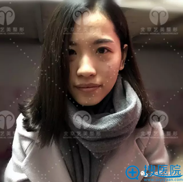 真人面部填充恢复日记告诉你北京艺美王东院长好不好