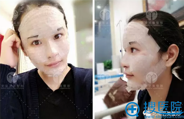 手术即刻侧面照片 手术即刻侧面照片