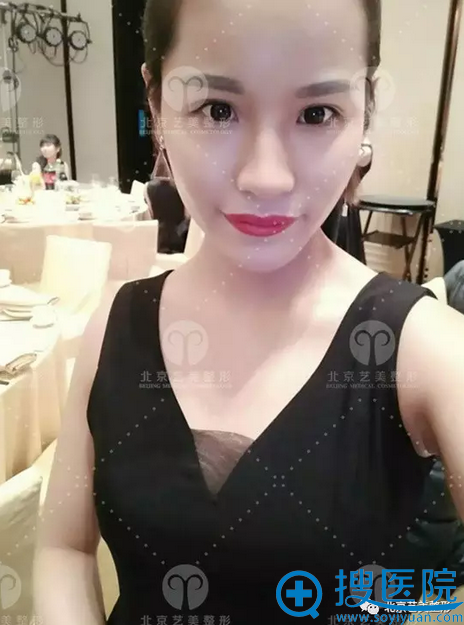术后一个月照片 术后一个月照片