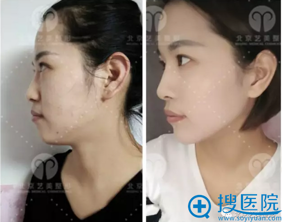 手术前后对比照片 手术前后对比照片