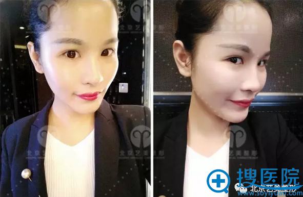 术后第三天侧面照片 术后第三天侧面照片