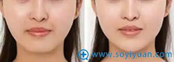 <!--<i data=20240710 data-id=12082></i>-->整形医院玻尿酸丰下巴<span style= <!--<i data=20240710 data-id=12082></i>-->整形医院玻尿酸丰下巴<span style=